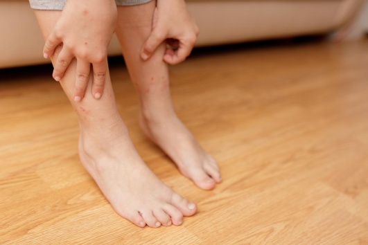 démangeaison liée aux puces de parquet